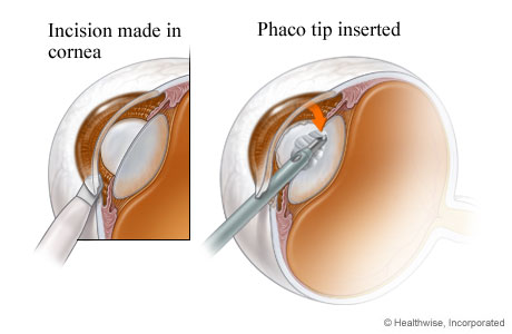 Incisions and opening created to begin cataract surgery