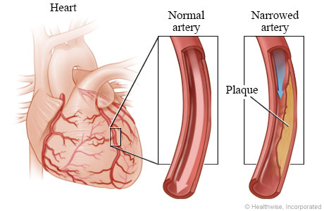 Normal coronary artery and artery narrowed by plaque