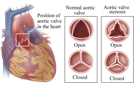 Location of aortic valve in heart with detail of normal open and closed valve and one with stenosis