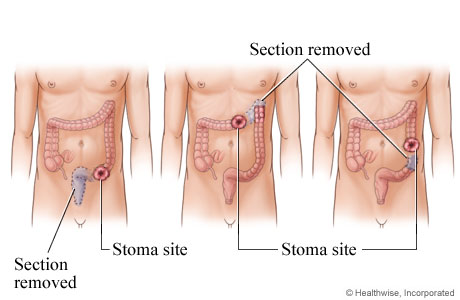 Possible stoma sites