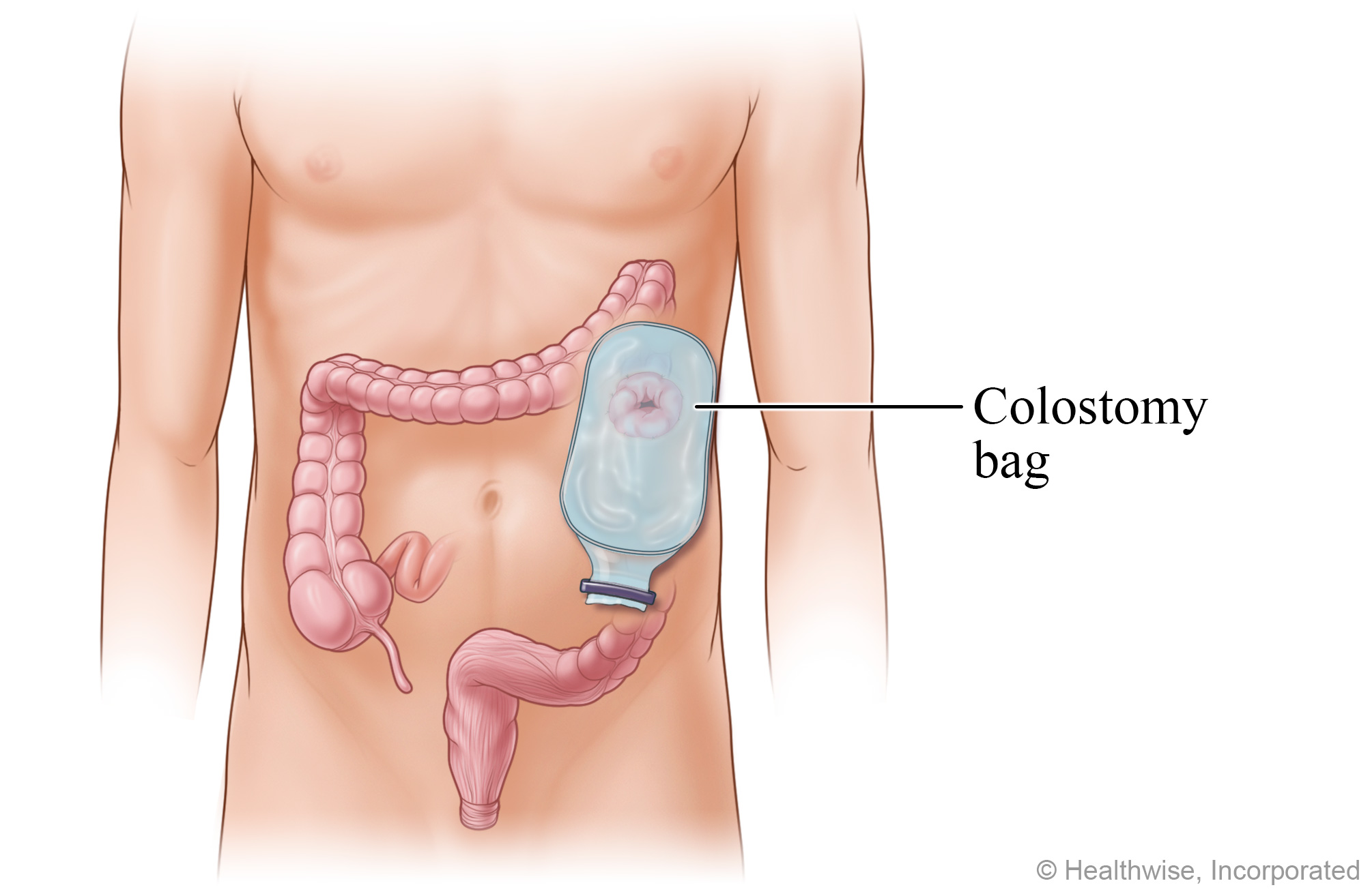 A colostomy bag positioned on the stoma