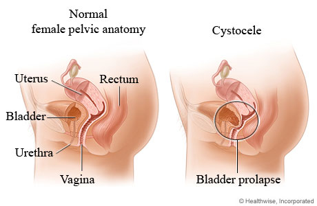 Understanding Cystocele (Prolapsed Bladder)