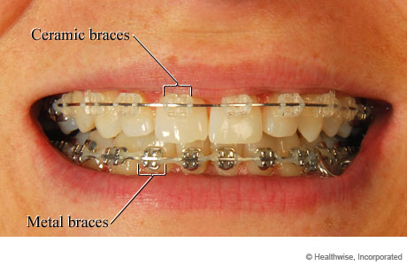 Metal Braces or Ceramic Braces: Which Ones to Choose?