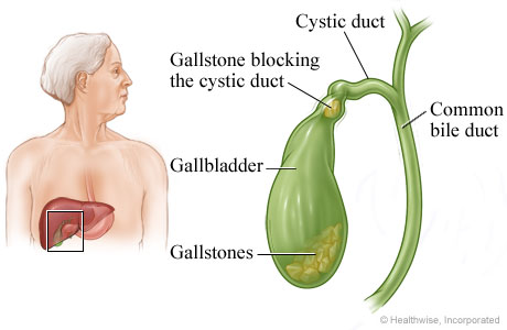 Gallbladder and gallstones