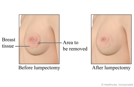 Lumpectomy for Breast Cancer: Uses, Procedure, Results