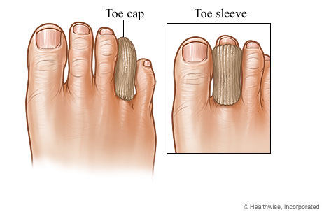 Toe Cap And Sleeve For Corns And Calluses - Health Library