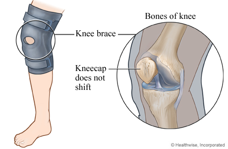 Knee Brace for Patellar Tracking Disorder Video & Image