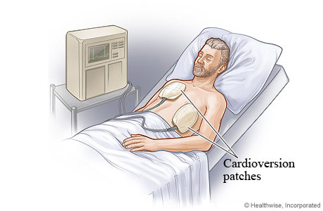 Electrical cardioversion with patches on chest.