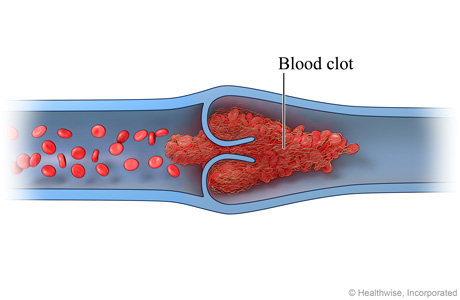 Blood Clots - Ellison Vein Institute