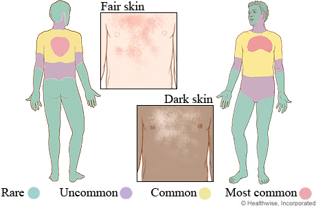 Tinea versicolor on fair skin and dark skin, and where it occurs on the body.