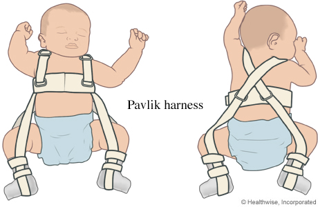 Pavlik harness on a baby