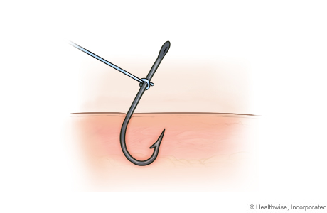 String-pull method for removing a fishhook