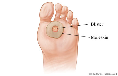 Doughnut-shaped pad surrounding blister on bottom of foot.