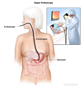 Upper endoscopy; drawing shows an endoscope (a thin, lighted tube) inserted through the mouth and down the throat into the esophagus and stomach. An inset shows a patient on a table having an upper endoscopy.