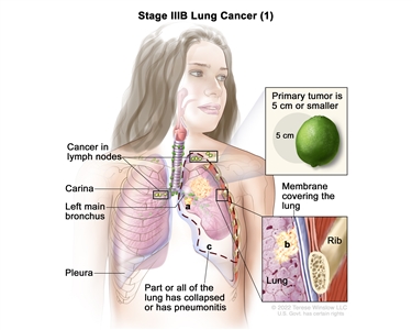 Stage IIIB lung cancer (1); drawing shows a primary tumor (5 cm or smaller) in the left lung and cancer in lymph nodes above the collarbone on the same side of the chest as the primary tumor and in lymph nodes on the opposite side of the chest as the primary tumor. Also shown is cancer that has spread to (a) the left main bronchus and (b) the membrane covering the lung. Also shown is (c) part or all of the lung has collapsed or has pneumonitis (inflammation). The carina, pleura, and a rib (inset) are also shown.