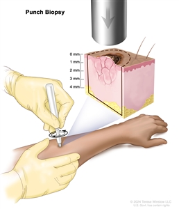 Punch biopsy; drawing shows a hollow, circular scalpel being inserted into a lesion on the skin of a patient's forearm. The instrument is turned clockwise and counterclockwise to cut into the skin and a small sample of tissue is removed to be checked under a microscope. The pullout shows that the instrument cuts down about 4 millimeters (mm) to the layer of fatty tissue below the dermis.
