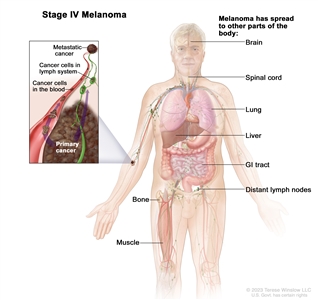 Stage IV melanoma; drawing shows other parts of the body where melanoma may spread, including the brain, spinal cord, lung, liver, gastrointestinal (GI) tract, bone, muscle, and distant lymph nodes. An inset shows cancer cells spreading through the blood and lymph system to another part of the body where a metastatic tumor has formed.