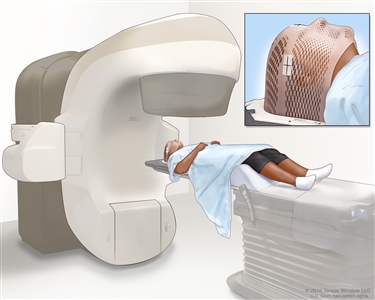 External-beam radiation therapy of the brain; drawing shows a patient lying on a table under a machine that is used to aim high-energy radiation. An inset shows a mesh mask that helps keep the patient's head from moving during treatment. The mask has pieces of white tape with small ink marks on it. The ink marks are used to line up the radiation machine in the same position before each treatment.