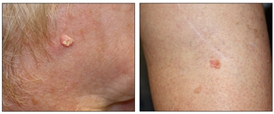 Photographs showing the side of a person's face with a skin cancer lesion that looks raised and crusty (left panel) and a person's leg with a skin cancer lesion that looks pink and raised (right panel).