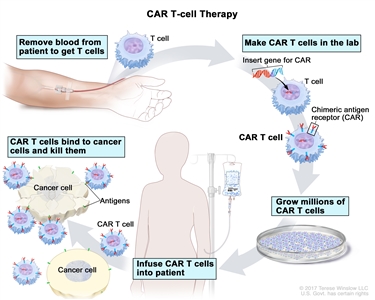 CAR T-cell therapy; drawing of blood being removed from a vein in a patient's arm to get T cells. Also shown is a special receptor called a chimeric antigen receptor (CAR) being made in the laboratory; the gene for CAR is inserted into the T cells and then millions of CAR T cells are grown. Drawing also shows the CAR T cells being given to the patient by infusion and binding to antigens on the cancer cells and killing them.