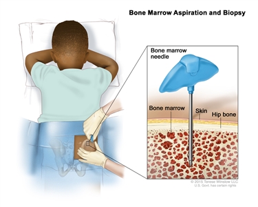 Bone marrow aspiration and biopsy; drawing shows a child lying face down on a table and a bone marrow needle being inserted into the right hip bone. An inset shows the bone marrow needle being inserted through the skin into the bone marrow of the hip bone.