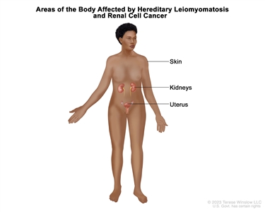 Drawing showing areas of the body affected by hereditary leiomyomatosis and renal cell cancer, including the skin, kidneys, and uterus.