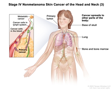 Stage IV nonmelanoma skin cancer of the head and neck (3); drawing shows a primary tumor on the face and other parts of the body where nonmelanoma skin cancer may spread, including the base of the skull, the lung, and the bone and bone marrow. An inset shows cancer cells spreading through the blood and lymph system to another part of the body where metastatic cancer has formed.