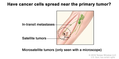 Melanoma staging (in-transit metastases, satellite tumors, and microsatellite tumors); drawing shows in-transit metastases in a lymph vessel more than 2 centimeters away from the primary tumor and satellite tumors within 2 centimeters of the primary tumor. Microsatellite tumors are not shown because they can only be seen with a microscope.