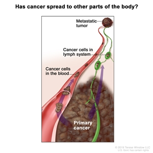 Melanoma staging (cancer spread to other parts of the body); drawing shows cancer cells spreading from the primary cancer, through the blood and lymph system, to another part of the body where a metastatic tumor has formed.