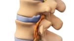 Lumbar Discectomy: Before Your Surgery