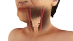 Carotid Artery Procedures: Stroke Prevention