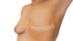 Mastectomy for Breast Cancer: Before Your Surgery