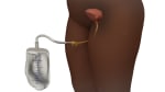 Care in the Hospital: Preventing a Urinary Catheter Infection