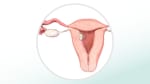Uterine fibroids: Fast facts