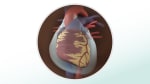 Pericardial effusion: Fast facts