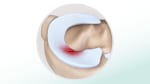 Meniscus tear: Fast Facts