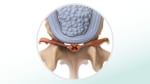 Lumbar spinal stenosis: Fast Facts
