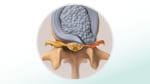 Herniated disc: Fast Facts