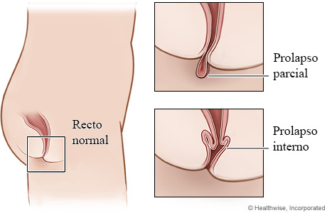 Prolapso rectal: parcial e interno