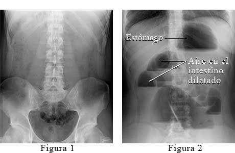 Radiografía abdominal de una obstrucción intestinal.