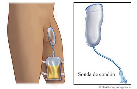Sonda de condón sobre el pene que drena la orina de la sonda a una bolsa de drenaje sujeta a la pierna con correas