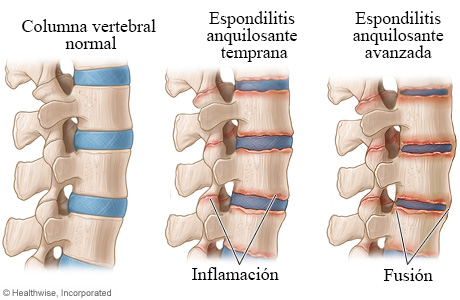 Las etapas de la espondilitis anquilosante en la columna.