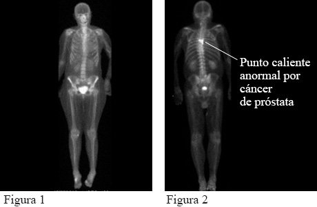 Imagen de una gammagrafía ósea que muestra cáncer de próstata