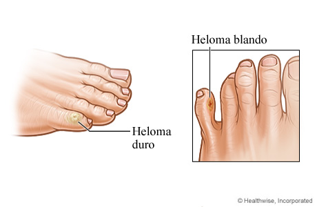 Helomas (ojos de gallo) duros y blandos en los dedos de los pies.