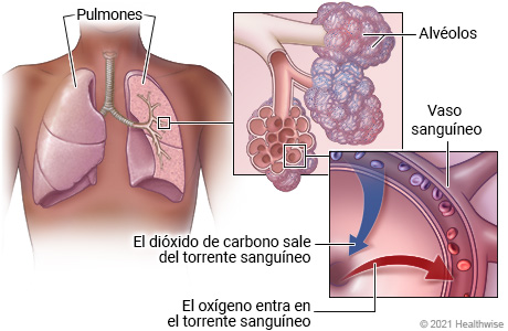 Alt text: Ubicación de los pulmones en el tórax, con detalle de los alvéolos y del intercambio de gases entre el alvéolo y el capilar