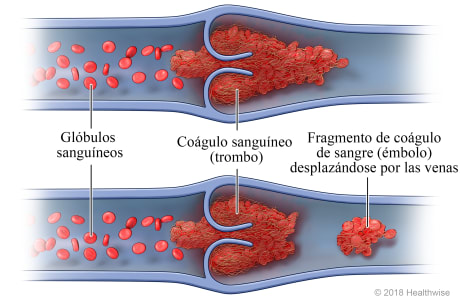Corte transversal de una vena, que muestra glóbulos sanguíneos, un coágulo de sangre (trombo) y un trozo del coágulo de sangre (émbolo) que se ha desprendido del trombo y se desplaza por la vena.