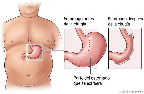 Ubicación del estómago en la parte superior del abdomen, con detalle del estómago antes y después de la gastrectomía en manga