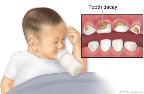 Bebé durmiendo con el biberón en la boca, con detalle de la boca mostrando caries en los dientes frontales superiores