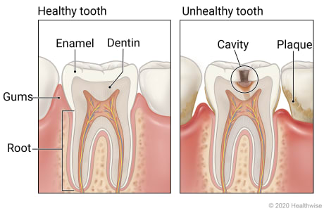 Diente sano que muestra las capas de esmalte, dentina y raíz, y diente enfermo con placa que muestra la caries que afecta a las capas del diente.
