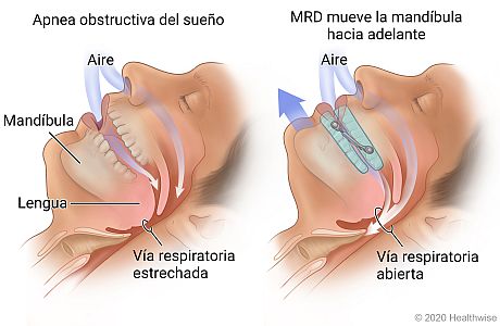Persona durmiendo con la vía respiratoria estrechada a causa de la apnea del sueño, y luego usando MRD donde se muestra la mandíbula movida hacia adelante y la vía respiratoria abierta
